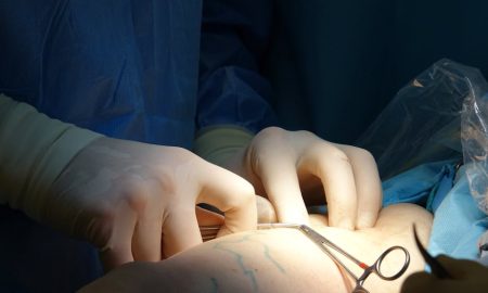 When to worry about varicose veins?