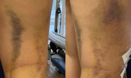Hematoma vs bruise: Key differences.